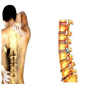 Etapele osteochondrozei