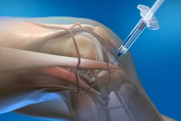 Injecții intraticulare pentru artroza articulației genunchiului