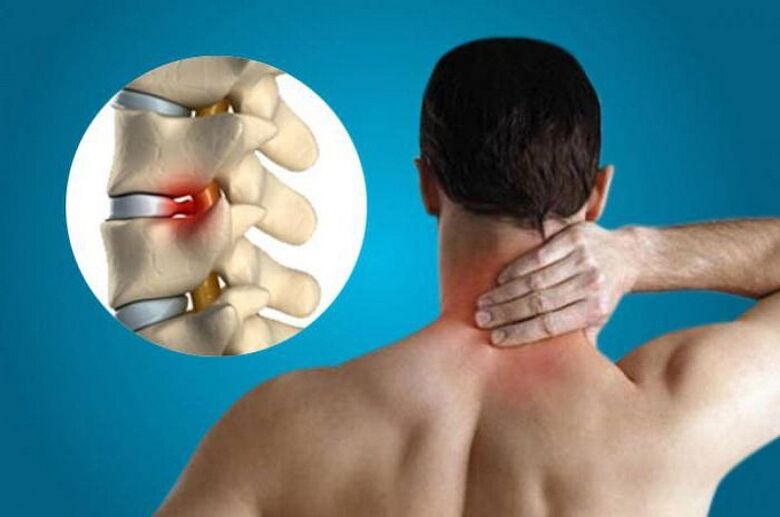 afectarea vertebrelor cervicale din cauza osteocondrozei