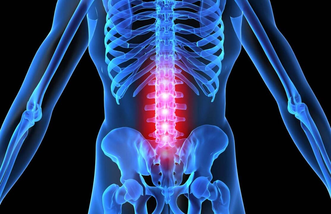 Simptome și tratament al osteocondrozei coloanei vertebrale lombare - Hondrostrong