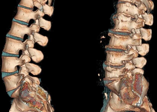 Osteocondroza coloanei vertebrale la o scanare CT